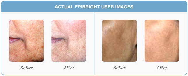 Epibright Case Studies After Before